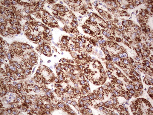 LRRC6 Antibody - Immunohistochemical staining of paraffin-embedded Carcinoma of Human liver tissue using anti-LRRC6 mouse monoclonal antibody.  Dilution: 1:150