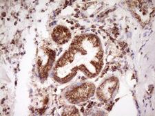 LRRC6 Antibody - Immunohistochemical staining of paraffin-embedded Carcinoma of Human lung tissue using anti-LRRC6 mouse monoclonal antibody. (Heat-induced epitope retrieval by 1 mM EDTA in 10mM Tris, pH8.5, 120C for 3min,