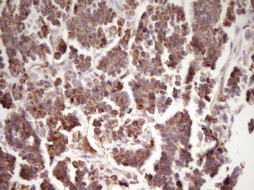 LRRC6 Antibody - Immunohistochemical staining of paraffin-embedded Adenocarcinoma of Human ovary tissue using anti-LRRC6 mouse monoclonal antibody. (Heat-induced epitope retrieval by 1 mM EDTA in 10mM Tris, pH8.5, 120C for 3min,