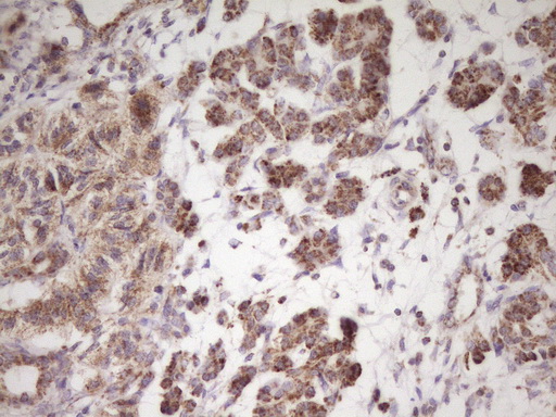 LRRC6 Antibody - Immunohistochemical staining of paraffin-embedded Carcinoma of Human pancreas tissue using anti-LRRC6 mouse monoclonal antibody. (Heat-induced epitope retrieval by 1 mM EDTA in 10mM Tris, pH8.5, 120C for 3min,