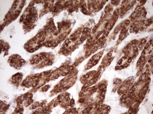 LRRC6 Antibody - Immunohistochemical staining of paraffin-embedded Carcinoma of Human liver tissue using anti-LRRC6 mouse monoclonal antibody. (Heat-induced epitope retrieval by 1 mM EDTA in 10mM Tris, pH8.5, 120C for 3min,