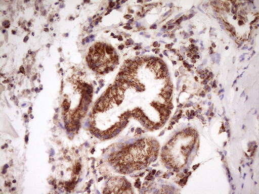 LRRC6 Antibody - IHC of paraffin-embedded Carcinoma of Human lung tissue using anti-LRRC6 mouse monoclonal antibody. (Heat-induced epitope retrieval by 1 mM EDTA in 10mM Tris, pH8.5, 120°C for 3min).