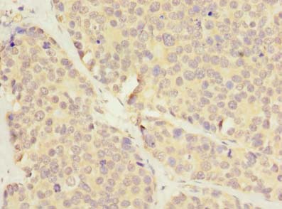 LRRC8E Antibody - Immunohistochemistry of paraffin-embedded human gastric cancer using antibody at dilution of 1:100.