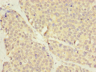 LRRC8E Antibody - Immunohistochemistry of paraffin-embedded human gastric cancer using LRRC8E Antibody at dilution of 1:100