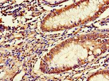 LRRIQ3 Antibody - Immunohistochemistry of paraffin-embedded human colon cancer at dilution 1:100
