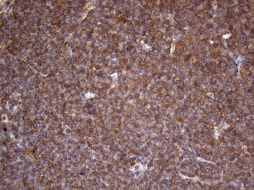 LRRTM1 Antibody - IHC of paraffin-embedded Human lymphoma tissue using anti-LRRTM1 mouse monoclonal antibody. (Heat-induced epitope retrieval by 1 mM EDTA in 10mM Tris, pH8.5, 120°C for 3min).