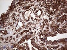 LRRTM1 Antibody - Immunohistochemical staining of paraffin-embedded Adenocarcinoma of Human ovary tissue using anti-LRRTM1 mouse monoclonal antibody. (Heat-induced epitope retrieval by 1 mM EDTA in 10mM Tris, pH8.5, 120C for 3min,