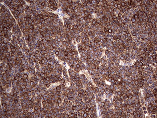 LRRTM1 Antibody - Immunohistochemical staining of paraffin-embedded Human lymphoma tissue using anti-LRRTM1 mouse monoclonal antibody. (Heat-induced epitope retrieval by 1 mM EDTA in 10mM Tris, pH8.5, 120C for 3min,