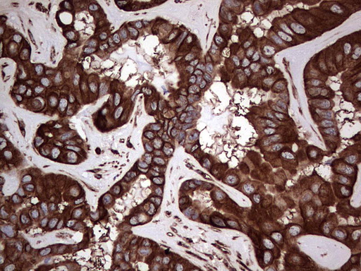LRRTM1 Antibody - Immunohistochemical staining of paraffin-embedded Carcinoma of Human liver tissue using anti-LRRTM1 mouse monoclonal antibody. (Heat-induced epitope retrieval by 1 mM EDTA in 10mM Tris, pH8.5, 120C for 3min,
