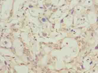 LRTM1 Antibody - Immunohistochemistry of paraffin-embedded human pancreatic cancer using antibody at dilution of 1:100.