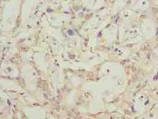 LRTM1 Antibody - Immunohistochemistry of paraffin-embedded human pancreatic cancer using antibody at dilution of 1:100.