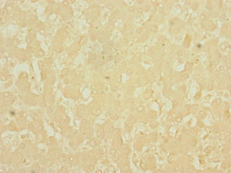 LSD / DNASE1L3 Antibody - Immunohistochemistry of paraffin-embedded human liver cancer using DNASE1L3 Antibody at dilution of 1:100