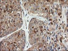 LSM1 Antibody - IHC of paraffin-embedded Adenocarcinoma of Human breast tissue using anti-LSM1 mouse monoclonal antibody.
