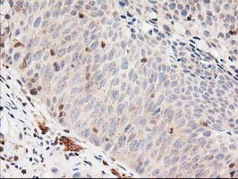 LSM1 Antibody - IHC of paraffin-embedded Carcinoma of Human bladder tissue using anti-LSM1 mouse monoclonal antibody.