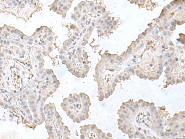 LSM10 Antibody - Immunohistochemistry of paraffin-embedded Human thyroid cancer tissue  using LSM10 Polyclonal Antibody at dilution of 1:50(×200)