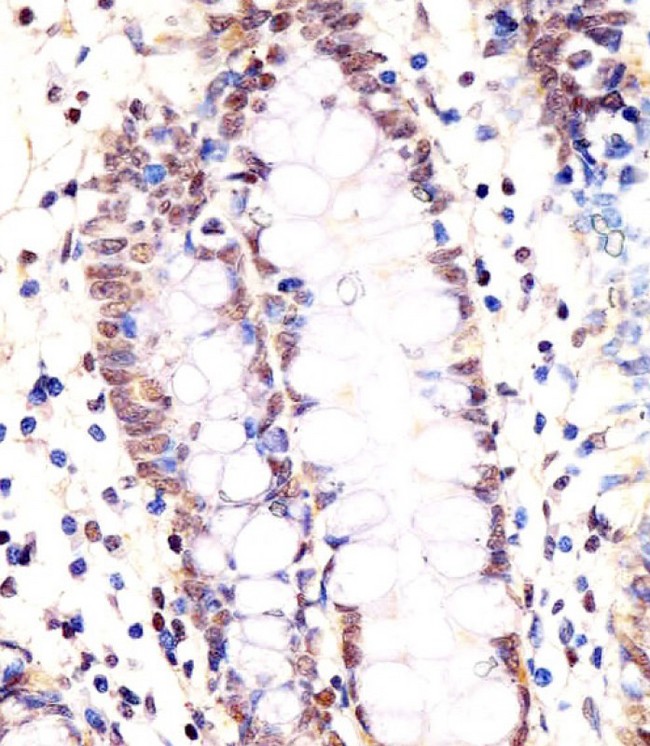 LSM2 / SnRNP Antibody - Antibody staining LSM2 in human colon tissue sections by Immunohistochemistry (IHC-P - paraformaldehyde-fixed, paraffin-embedded sections). Tissue was fixed with formaldehyde and blocked with 3% BSA for 0. 5 hour at room temperature; antigen retrieval was by heat mediation with a citrate buffer (pH 6). Samples were incubated with primary antibody (1:25) for 1 hours at 37°C. A undiluted biotinylated goat polyvalent antibody was used as the secondary antibody.
