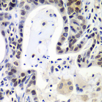 LSM2 / SnRNP Antibody - Immunohistochemistry of paraffin-embedded human gastric cancer tissue.
