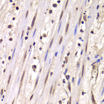 LSM4 Antibody - Immunohistochemistry of paraffin-embedded human mammary cancer tissue.