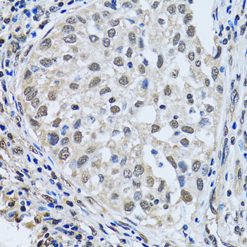 LSM4 Antibody - Immunohistochemistry of paraffin-embedded human lung cancer tissue.