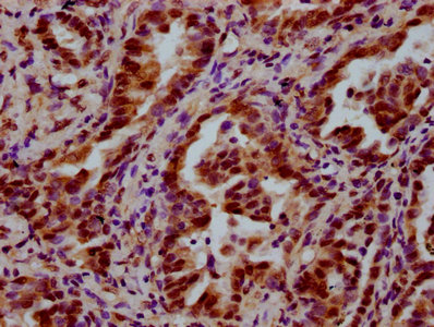 LSM8 / NAA38 Antibody - Immunohistochemistry Dilution at 1:600 and staining in paraffin-embedded human lung cancer performed on a Leica BondTM system. After dewaxing and hydration, antigen retrieval was mediated by high pressure in a citrate buffer (pH 6.0). Section was blocked with 10% normal Goat serum 30min at RT. Then primary antibody (1% BSA) was incubated at 4°C overnight. The primary is detected by a biotinylated Secondary antibody and visualized using an HRP conjugated SP system.