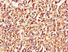 LSMEM1 / C7orf53 Antibody - Immunohistochemistry of paraffin-embedded human melanoma using LSMEM1 Antibody at dilution of 1:100