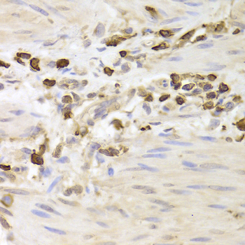 LSP1 Antibody - Immunohistochemistry of paraffin-embedded Human gastric cancer tissue.