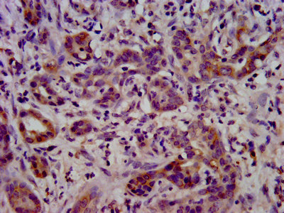 LSR / LISCH7 Antibody - IHC image of LSR Antibody diluted at 1:400 and staining in paraffin-embedded human pancreatic cancer performed on a Leica BondTM system. After dewaxing and hydration, antigen retrieval was mediated by high pressure in a citrate buffer (pH 6.0). Section was blocked with 10% normal goat serum 30min at RT. Then primary antibody (1% BSA) was incubated at 4°C overnight. The primary is detected by a biotinylated secondary antibody and visualized using an HRP conjugated SP system.