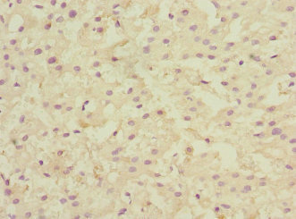 LSS Antibody - Immunohistochemistry of paraffin-embedded human liver cancer at dilution 1:100