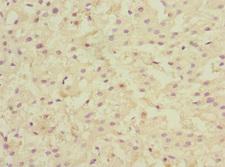 LSS Antibody - Immunohistochemistry of paraffin-embedded human liver cancer at dilution 1:100