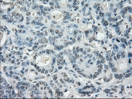 LTA4H / LTA4 Antibody - Immunohistochemical staining of paraffin-embedded Adenocarcinoma of colon tissue using anti-LTA4H mouse monoclonal antibody. (Dilution 1:50).