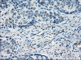 LTA4H / LTA4 Antibody - Immunohistochemical staining of paraffin-embedded Adenocarcinoma of ovary tissue using anti-LTA4H mouse monoclonal antibody. (Dilution 1:50).