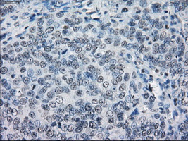 LTA4H / LTA4 Antibody - IHC of paraffin-embedded Adenocarcinoma of ovary tissue using anti-LTA4H mouse monoclonal antibody. (Dilution 1:50).