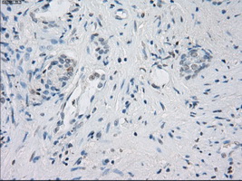 LTA4H / LTA4 Antibody - IHC of paraffin-embedded Carcinoma of prostate tissue using anti-LTA4H mouse monoclonal antibody. (Dilution 1:50).