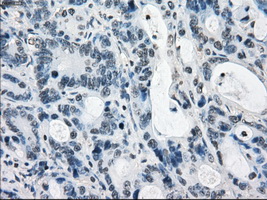 LTA4H / LTA4 Antibody - IHC of paraffin-embedded Adenocarcinoma of colon tissue using anti-LTA4H mouse monoclonal antibody. (Dilution 1:50).