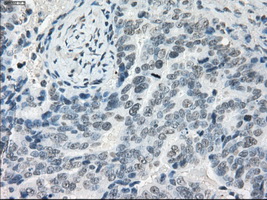 LTA4H / LTA4 Antibody - IHC of paraffin-embedded Adenocarcinoma of ovary tissue using anti-LTA4H mouse monoclonal antibody. (Dilution 1:50).
