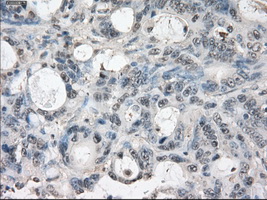 LTA4H / LTA4 Antibody - IHC of paraffin-embedded Adenocarcinoma of colon tissue using anti-LTA4H mouse monoclonal antibody. (Dilution 1:50).