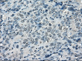 LTA4H / LTA4 Antibody - IHC of paraffin-embedded Carcinoma of bladder tissue using anti-LTA4H mouse monoclonal antibody. (Dilution 1:50).