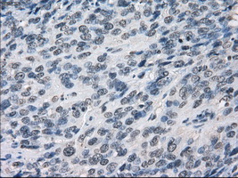 LTA4H / LTA4 Antibody - IHC of paraffin-embedded Carcinoma of bladder tissue using anti-LTA4H mouse monoclonal antibody. (Dilution 1:50).
