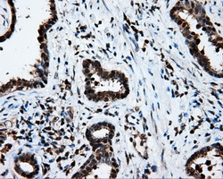 LTA4H / LTA4 Antibody - IHC of paraffin-embedded Carcinoma of prostate tissue using anti-LTA4H mouse monoclonal antibody. (Dilution 1:50).