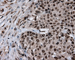 LTA4H / LTA4 Antibody - Immunohistochemical staining of paraffin-embedded Adenocarcinoma of breast tissue using anti-LTA4H mouse monoclonal antibody. (Dilution 1:50).