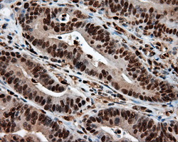 LTA4H / LTA4 Antibody - Immunohistochemical staining of paraffin-embedded Adenocarcinoma of colon tissue using anti-LTA4H mouse monoclonal antibody. (Dilution 1:50).