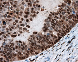LTA4H / LTA4 Antibody - Immunohistochemical staining of paraffin-embedded Adenocarcinoma of ovary tissue using anti-LTA4H mouse monoclonal antibody. (Dilution 1:50).