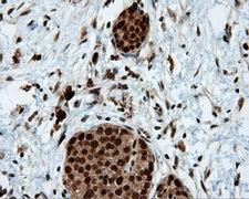 LTA4H / LTA4 Antibody - Immunohistochemical staining of paraffin-embedded Carcinoma of pancreas tissue using anti-LTA4H mouse monoclonal antibody. (Dilution 1:50).