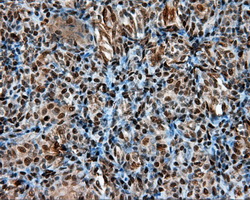 LTA4H / LTA4 Antibody - Immunohistochemical staining of paraffin-embedded Carcinoma of thyroid tissue using anti-LTA4H mouse monoclonal antibody. (Dilution 1:50).
