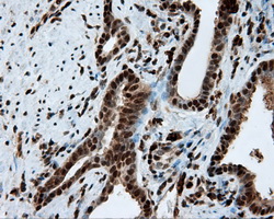 LTA4H / LTA4 Antibody - Immunohistochemical staining of paraffin-embedded Carcinoma of prostate tissue using anti-LTA4H mouse monoclonal antibody. (Dilution 1:50).