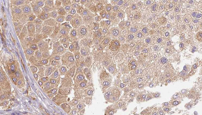 LTBP1 / LTBP-1 Antibody - 1:100 staining human Melanoma tissue by IHC-P. The sample was formaldehyde fixed and a heat mediated antigen retrieval step in citrate buffer was performed. The sample was then blocked and incubated with the antibody for 1.5 hours at 22°C. An HRP conjugated goat anti-rabbit antibody was used as the secondary.