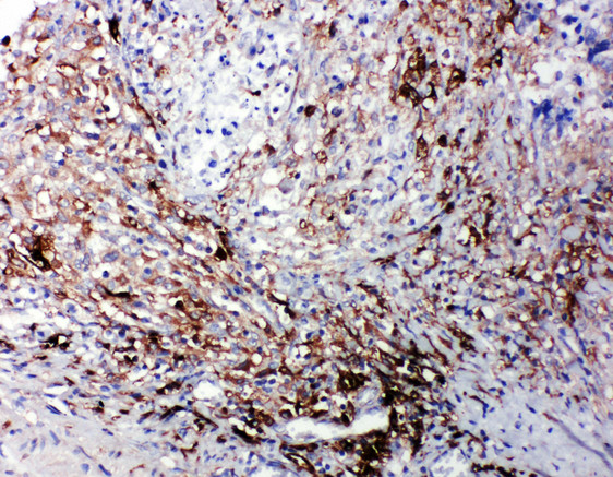 LTBR Antibody - LTBR antibody. IHC(P): Human Intestinal Cancer Tissue.
