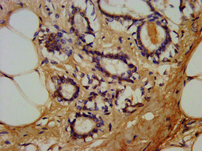 LTBR Antibody - Immunohistochemistry Dilution at 1:180 and staining in paraffin-embedded human breast cancer performed on a Leica BondTM system. After dewaxing and hydration, antigen retrieval was mediated by high pressure in a citrate buffer (pH 6.0). Section was blocked with 10% normal Goat serum 30min at RT. Then primary antibody (1% BSA) was incubated at 4°C overnight. The primary is detected by a biotinylated Secondary antibody and visualized using an HRP conjugated SP system.