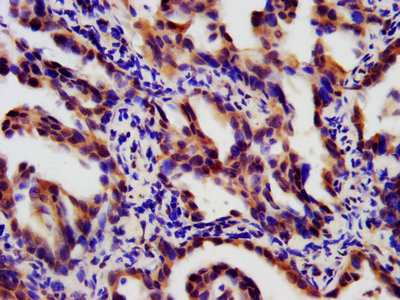 LTBR Antibody - Immunohistochemistry Dilution at 1:180 and staining in paraffin-embedded human lung cancer performed on a Leica BondTM system. After dewaxing and hydration, antigen retrieval was mediated by high pressure in a citrate buffer (pH 6.0). Section was blocked with 10% normal Goat serum 30min at RT. Then primary antibody (1% BSA) was incubated at 4°C overnight. The primary is detected by a biotinylated Secondary antibody and visualized using an HRP conjugated SP system.