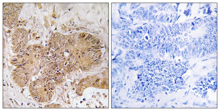 LUC7L2 Antibody - Peptide - + Immunohistochemistry analysis of paraffin-embedded human colon carcinoma tissue using LUC7L2 antibody.